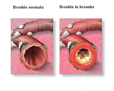 imagine cu bronsita acuta